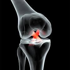 ACL injury